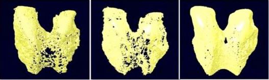 미세 CT 영상으로 퇴행성관절염에 걸린 실험용 쥐의 대퇴골 미세구조 변화를 관찰한 결과, 유산균 복합제 투여군〈오른쪽〉이 세레콕시브〈가운데〉보다 대퇴골 밀도가 가장 높은 것으로 나타남. 〈자료 : 가톨릭의대〉