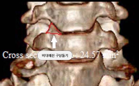 경추협착증 환자 3D CT: 비대해진 구상돌기 단면적