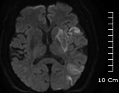 69세 남자 환자, 왼쪽의 하얗게 밝은 부위가 언어 중추에 생긴 뇌경색