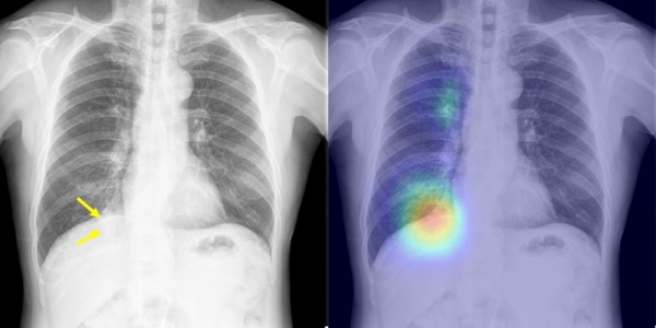 발열과 기침으로 응급실을 방문한 환자의 흉부 X선 영상 (좌측)이다. 우측 하부 폐의 폐렴 병변 (화살표)을 응급의학과 당직의사는 인지하지 못하였으나, 인공지능 시스템은 병변의 존재와 위치를 정확하게 식별했다 (우측).