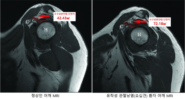 정상인-오십견 환자의 어깨 MRI