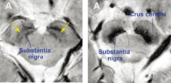 [사진] 정상 모양의 흑질(좌), 파킨슨병 환자의 흑질(우) MRI 영상