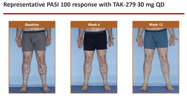                                    TAK-279로 치료한 건선 환자의 상태 변화. [사진=다케다제약]