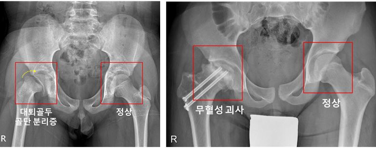  우측 고관절에 대퇴골두 골단 분리증 및 무혈성 괴사가 발생한 소아청소년 환자의 X-ray