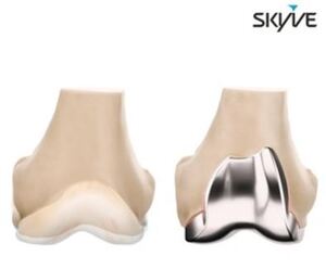 ㈜스카이브, 한국일보 '2025 우수특허대상' 선정... 의료진과 '연골 재구... - 뉴스 썸네일 이미지