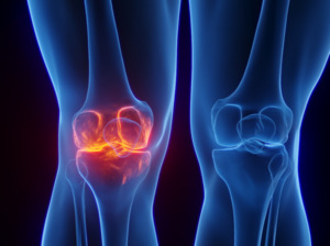 차세대 관절건강 소재 DEM 뜬다... 원료 쟁탈전 본격화 - 뉴스 썸네일 이미지